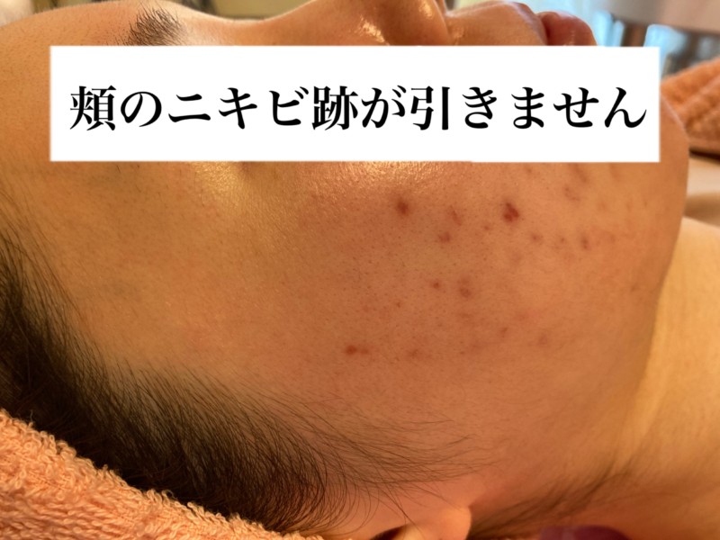 右頬のニキビ跡が確実に薄くなっています 大阪 堺市 ニキビ ニキビ跡の根本を解決し見違え肌に ニキビ専門エステ シエスタ
